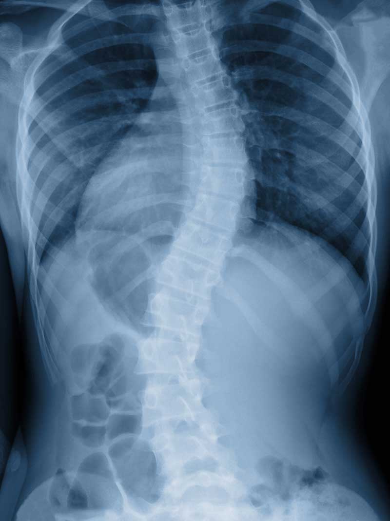 Scoliosis  Beaverton, OR 